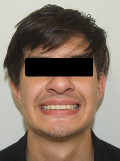 Frontal portrait of a teen patient with a corrected, straight smile after traditional braces treatment in Kendall