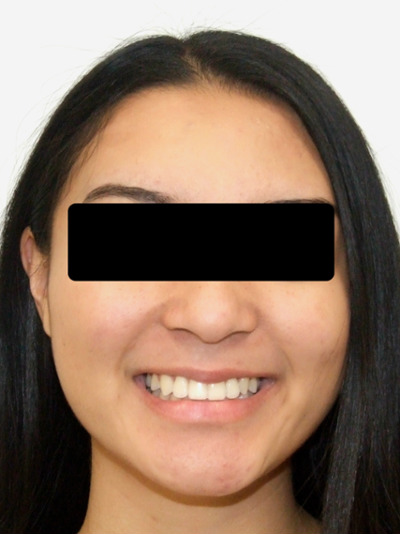 Successful alignment and a healthy smile following specialized orthodontic care in Kendall.