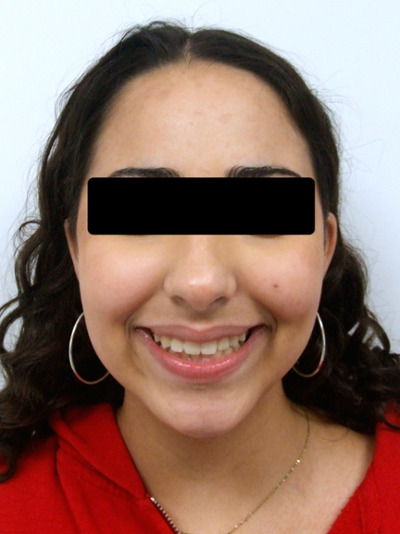 Retrato frontal de paciente preadolescente con una sonrisa amplia y alineada después de 30 meses de tratamiento con frenillos en Kendall.