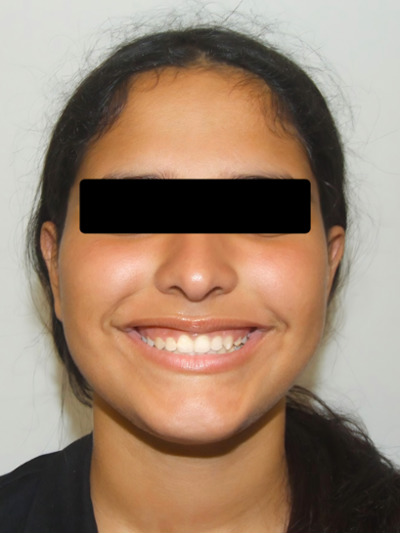 Portrait of a teenager showing a confident and straight smile after braces in Kendall.