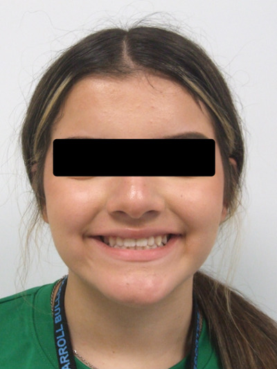 Portrait of the same teenager displaying a confident, continuous smile with perfectly aligned teeth.
