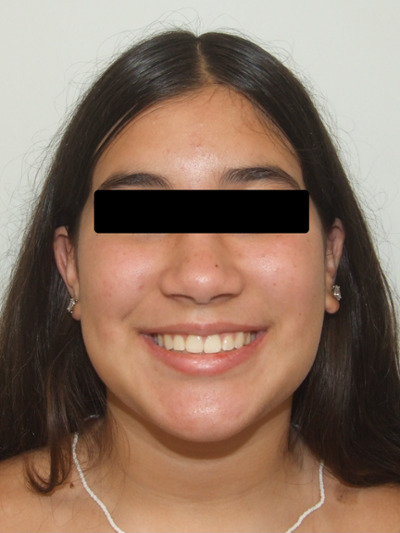Frontal portrait of a preteen with a broad, healthy smile after 30 months of comprehensive orthodontic treatment in Kendall.