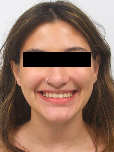 Full clinical portrait of the same student displaying a beautifully aligned smile following non-extraction treatment.