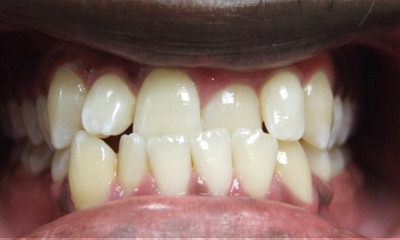Adult Class III patient with severe lower crowding and anterior crossbite before extraction therapy at Martinez Orthodontics Miami.
