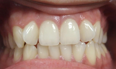 Moderate dental crowding and misaligned teeth in an adult before specialist orthodontic treatment in Kendall.