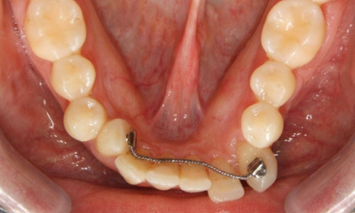 Adult with shifted teeth due to a broken fixed retainer before braces in The Crossings. 