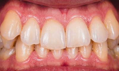 Adult patient with a collapsed maxillary arch, crossbite, and over-retained primary molars before RPE and braces at Martinez Orthodontics Miami.