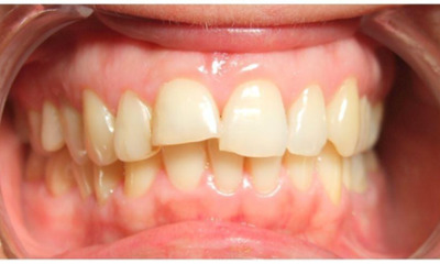 Adult-Protrusion-and-Midline-Correction-in-Miami-Before-Image