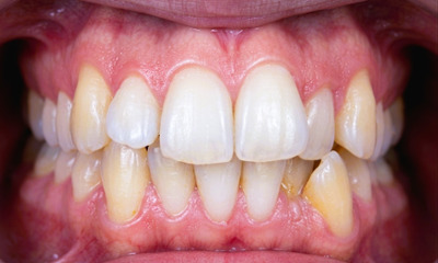 Adult braces Miami: Front teeth crowding before orthodontic treatment.