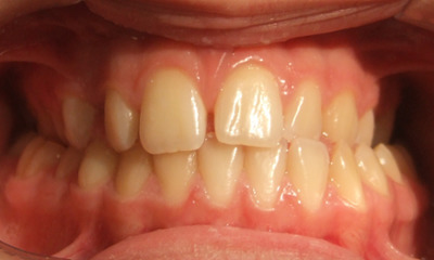 Underbite-and-Jaw-Shift-Correction-in-Miami-Before-Image