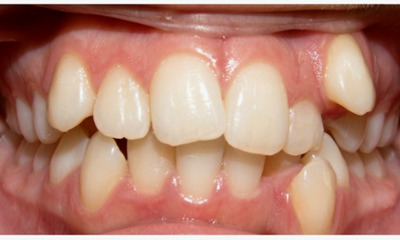 Severe dental crowding and ectopic canine before extraction and metal braces treatment in Miami.