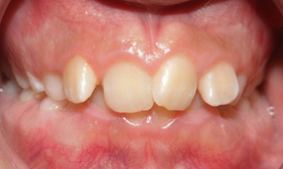 Preteen female with a deep bite where upper teeth completely hide the lower teeth and a gummy smile before braces in Kendall.