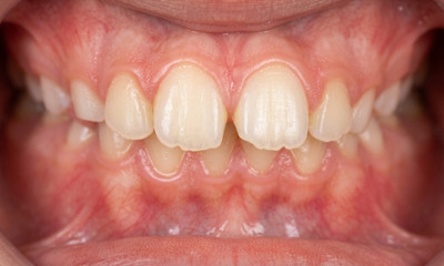 Preteen with a receded lower jaw, severely protruding front teeth, and a narrow upper arch before specialized appliance treatment in Kendall.