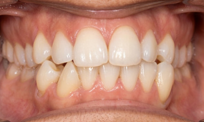 Dental crowding and overlapping teeth before orthodontic treatment at Martinez Orthodontics