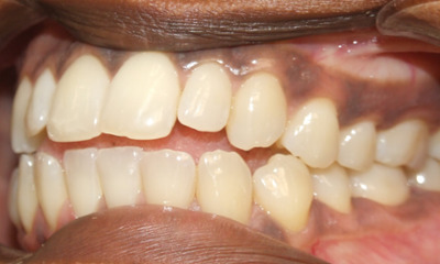 Clinical close-up of an adult female with a pronounced anterior open bite before orthodontic treatment.
