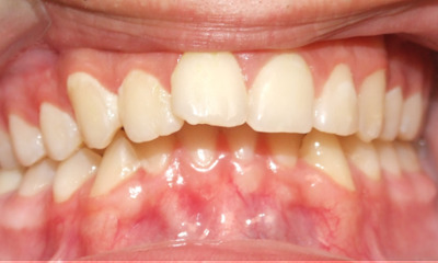 Protruded upper teeth and Class II malocclusion before braces and rubber bands in Kendall, Miami.