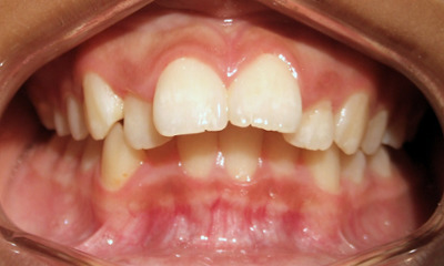 Preteen patient with severe overjet protrusion and moderate crowding before traditional metal braces treatment in Miami.