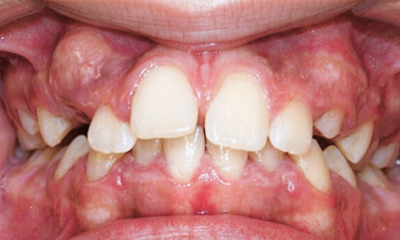 Preteen patient displaying large gaps and flared front teeth before braces treatment at Martinez Orthodontics Miami.