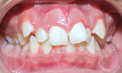 Severe dental crowding, blocked-out canines, and narrow arches before extraction and metal braces in Kendall, Miami.