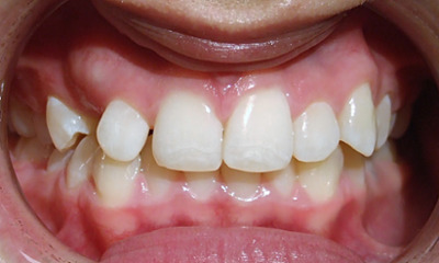 Teenager with Class I malocclusion and impacted canine #6 before braces and subsequent surgical exposure in Miami.