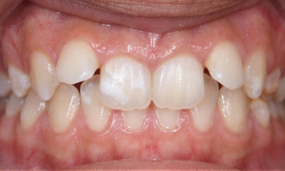 Teenager with a deep bite and angled side teeth before braces in Miami.