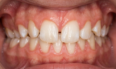 Close-up of a teen’s smile before braces showing a large gap between the front teeth, a deep bite, and a midline deviation where the teeth do not align with the center of the face.