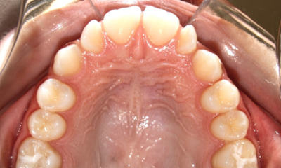 Upper dental arch photo showing noticeable gaps between the upper teeth due to small lateral incisors prior to treatment.