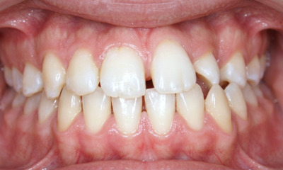 Teenage patient with an impacted upper canine, spacing, and shifted midline before traditional metal braces treatment in Miami.