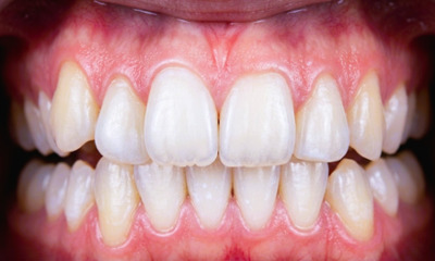 Teenage patient with posterior open bite and misplaced lower canine before traditional metal braces treatment in Miami.