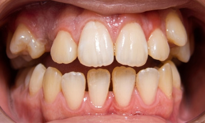 Young adult patient showing a front bite that does not close and a missing eyetooth before braces at Martinez Orthodontics Miami.