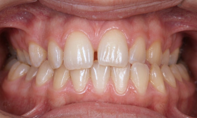 Underbite-and-Jaw-Shift-Correction-in-Miami-Before-Image