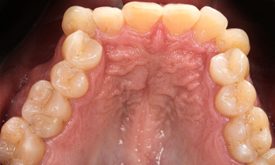 Intraoral occlusal view of a narrow, square-shaped maxillary arch in an adult patient before RPE treatment at Martinez Orthodontics Miami.