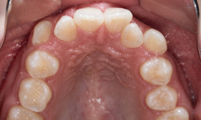 Initial clinical view of significant dental crowding and narrow arch width prior to specialist orthodontic treatment at Martinez Orthodontics Miami.