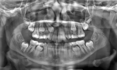 Panoramic X-ray showing the ectopic eruption of the upper right canine and the underlying dental structure being guided into proper position during the orthodontic process.