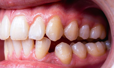 Intraoral side view of a lingually ectopic lower canine and posterior open bite before traditional metal braces in Miami