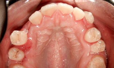 Top-down view of the upper jaw showing gaps and a missing canine before adult orthodontic treatment in Miami.