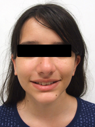 Patient smile portrait before specialized orthodontic care in Miami.