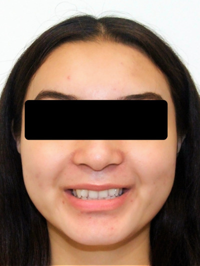 Initial dental crowding and overlapping teeth in an adult patient before orthodontic treatment in Kendall.