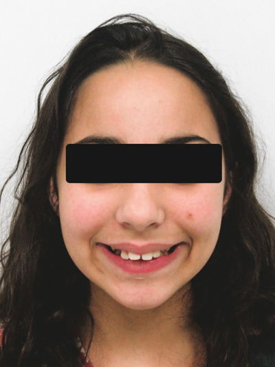 Retrato frontal de paciente preadolescente mostrando espacios y dientes salidos antes del tratamiento con frenillos en Martinez Orthodontics Miami.