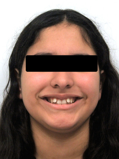 Portrait of a teenager with a deep bite before starting orthodontic care in Miami.