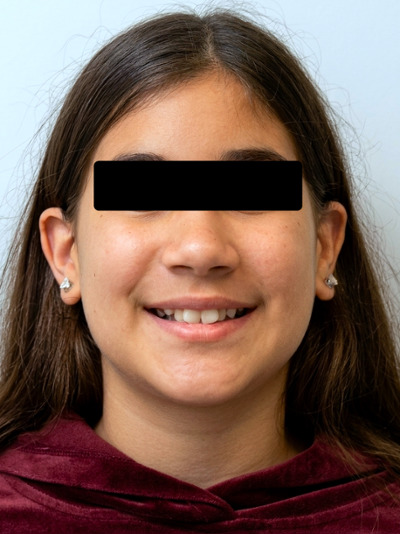 Frontal portrait of a preteen patient displaying a narrow smile and crowding before expansion and braces treatment at Martinez Orthodontics Miami.