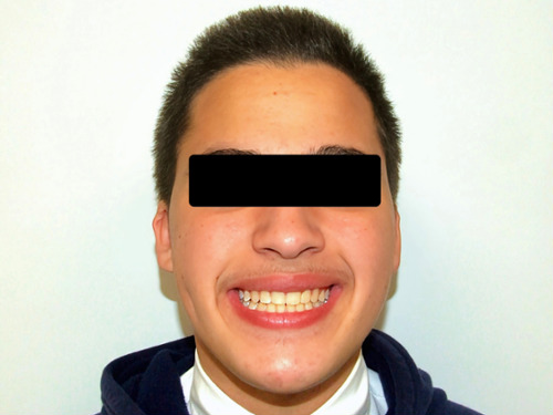Now My Son Has a Perfect Smile – Complex Orthodontic Correction
